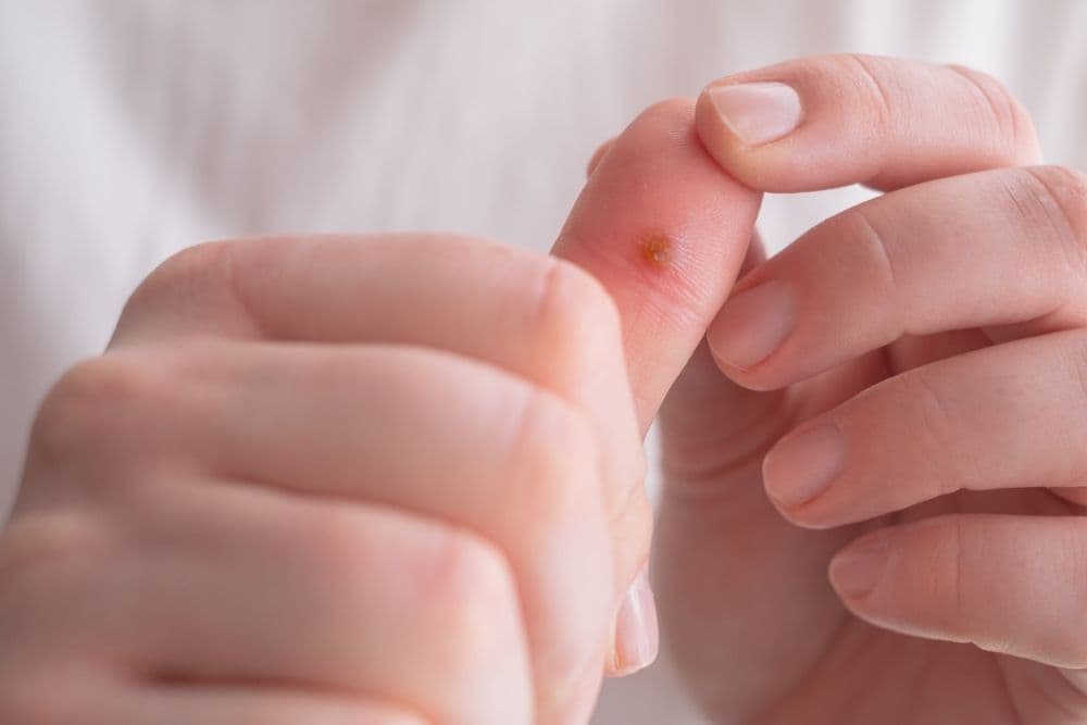 Infecção por HPV: diagnóstico, tratamento e prevenção!